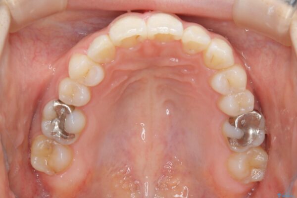 20代女性 生まれつき歯の本数が足りない先天欠如を治療する
