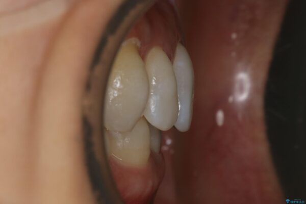 30代女性 歯根破折と歯列矯正の治療で噛み合わせを改善