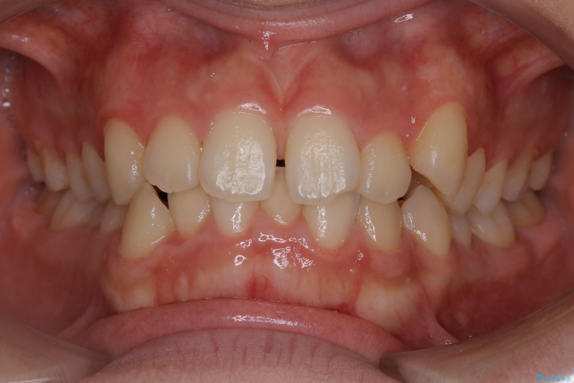 10代女性 すきっ歯（正中離開）のインビザライン治療 治療前