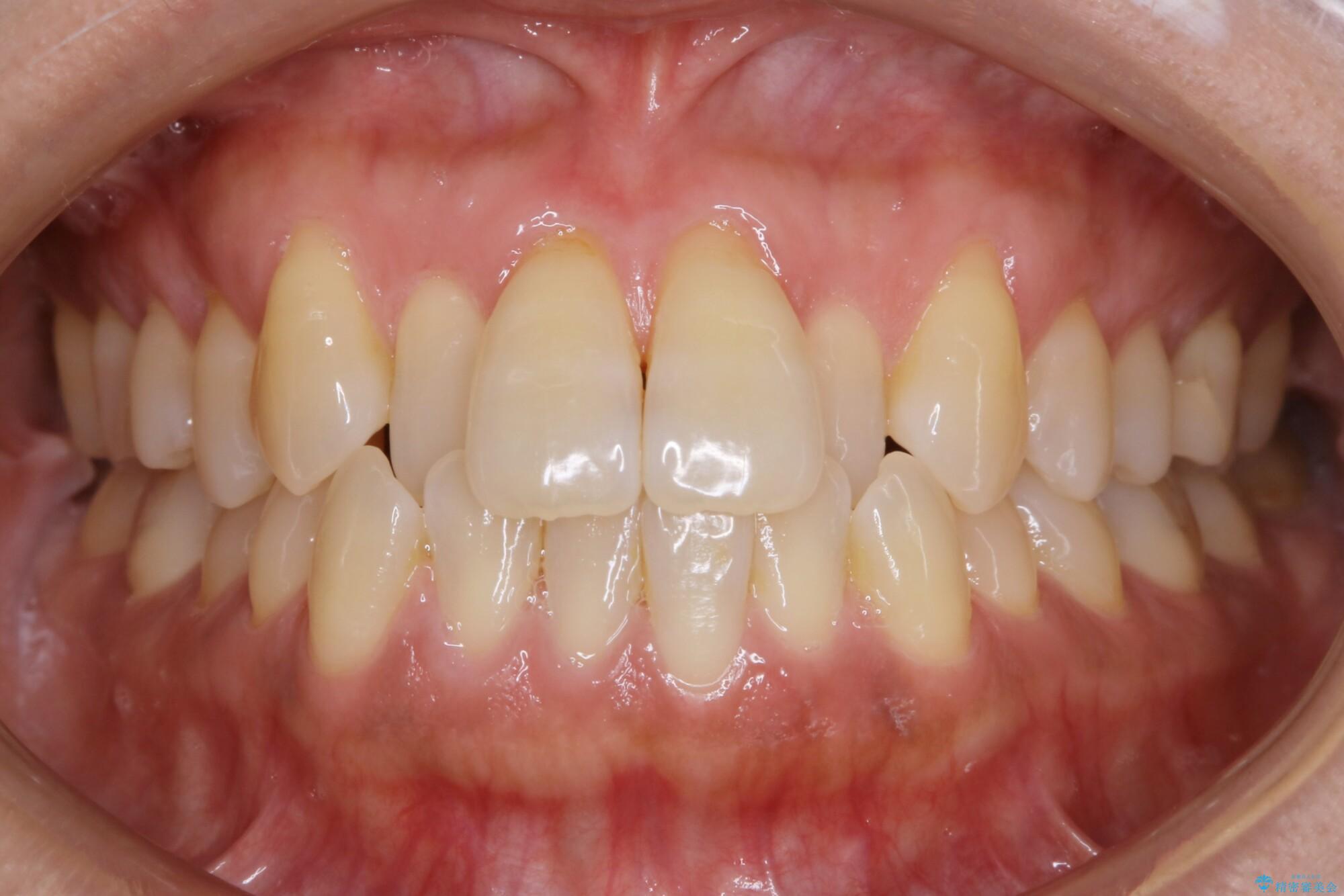 30代女性　短期間で非抜歯による反対咬合(受け口)の改善 治療前