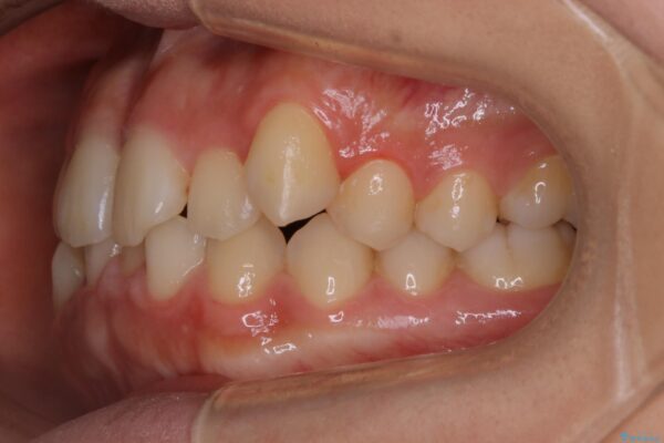 10代女性 すきっ歯（正中離開）のインビザライン治療