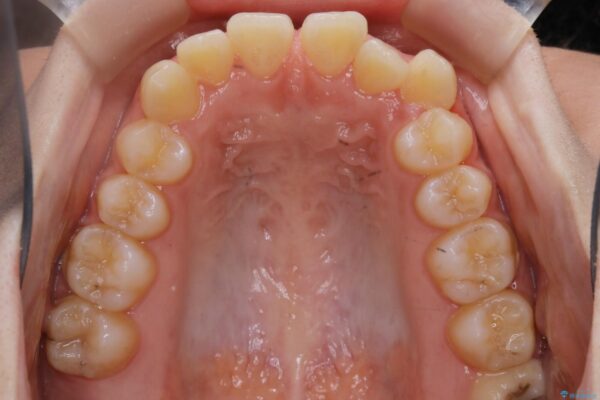 10代女性 すきっ歯（正中離開）のインビザライン治療