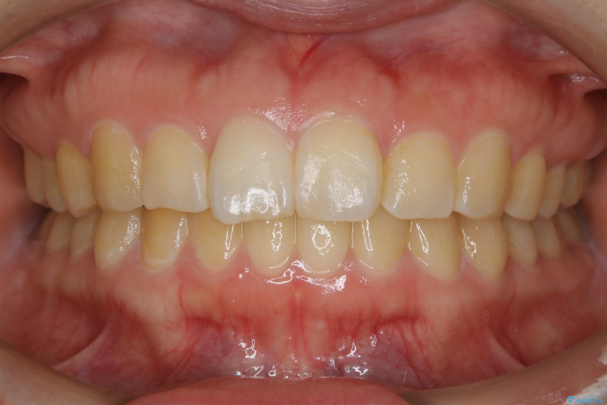 30代女性 歯を長持ちさせるための咬合調整 治療後