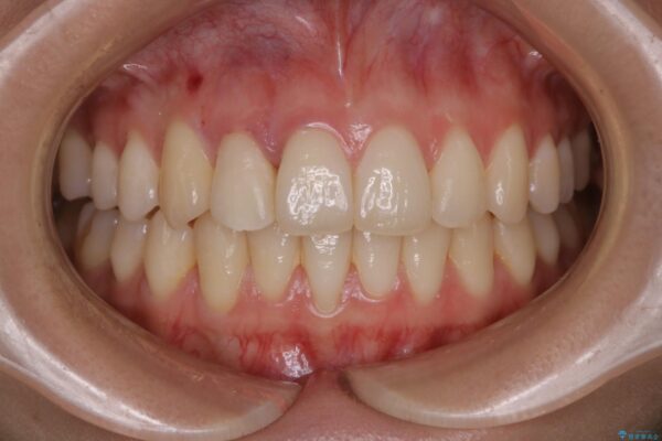20代女性 非抜歯でもガタガタを改善するインビザライン矯正