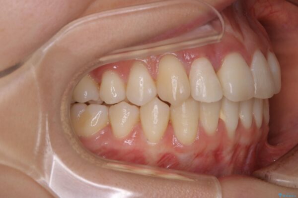 20代女性 非抜歯でもガタガタを改善するインビザライン矯正