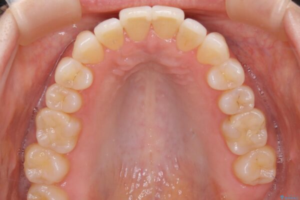 30代女性 短期間で非抜歯による反対咬合(受け口)の改善