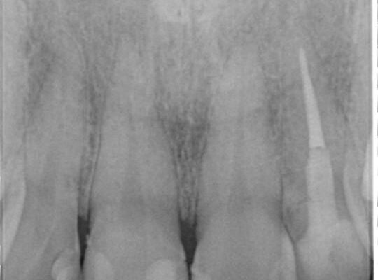 30代男性 神経一歩手前の深い虫歯をセラミッククラウンで治療