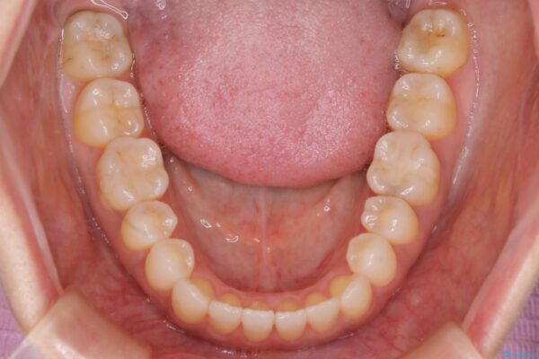 30代女性 短期間で非抜歯による反対咬合(受け口)の改善