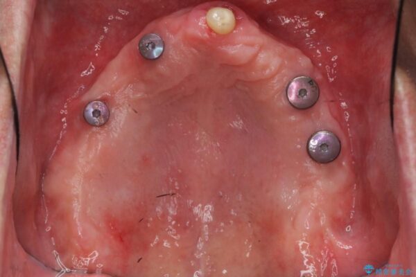 50代男性 重度の歯周病をインプラントを用いた上顎義歯（入れ歯）で補綴治療