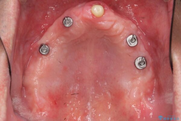 50代男性 重度の歯周病をインプラントを用いた上顎義歯（入れ歯）で補綴治療