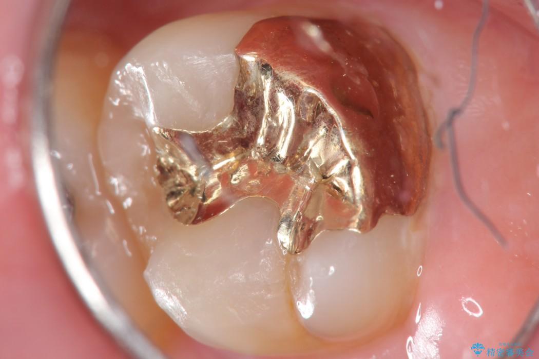20代男性 深い虫歯を長持ちするゴールドインレーで治療 治療後