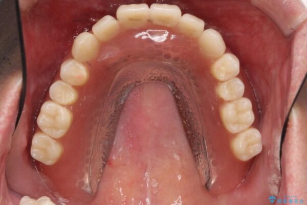50代男性 重度の歯周病をインプラントを用いた上顎義歯（入れ歯）で補綴治療