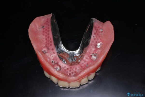 50代男性 重度の歯周病をインプラントを用いた上顎義歯（入れ歯）で補綴治療