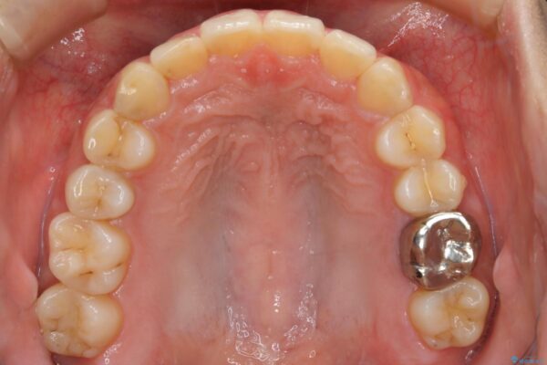 20代女性 非抜歯で口ゴボ改善するインビザライン矯正治療