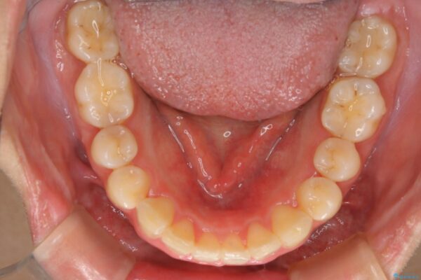 20代女性 非抜歯で口ゴボ改善するインビザライン矯正治療