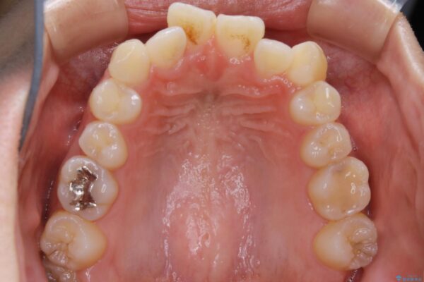 20代女性 前歯の真ん中（正中）のズレとガタつきを効率よく矯正する
