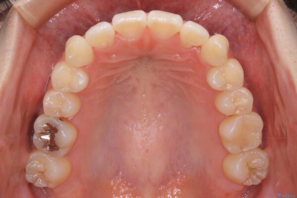 20代女性 前歯の真ん中（正中）のズレとガタつきを効率よく矯正する