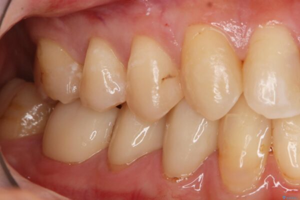 20代 女性　劣化した保険のプラスチックをセラミックへ