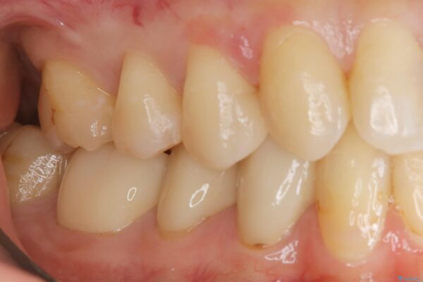 20代 女性　劣化した保険のプラスチックをセラミックへ