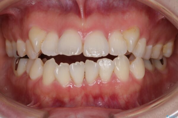 30代 女性 インビザラインで抜歯矯正
