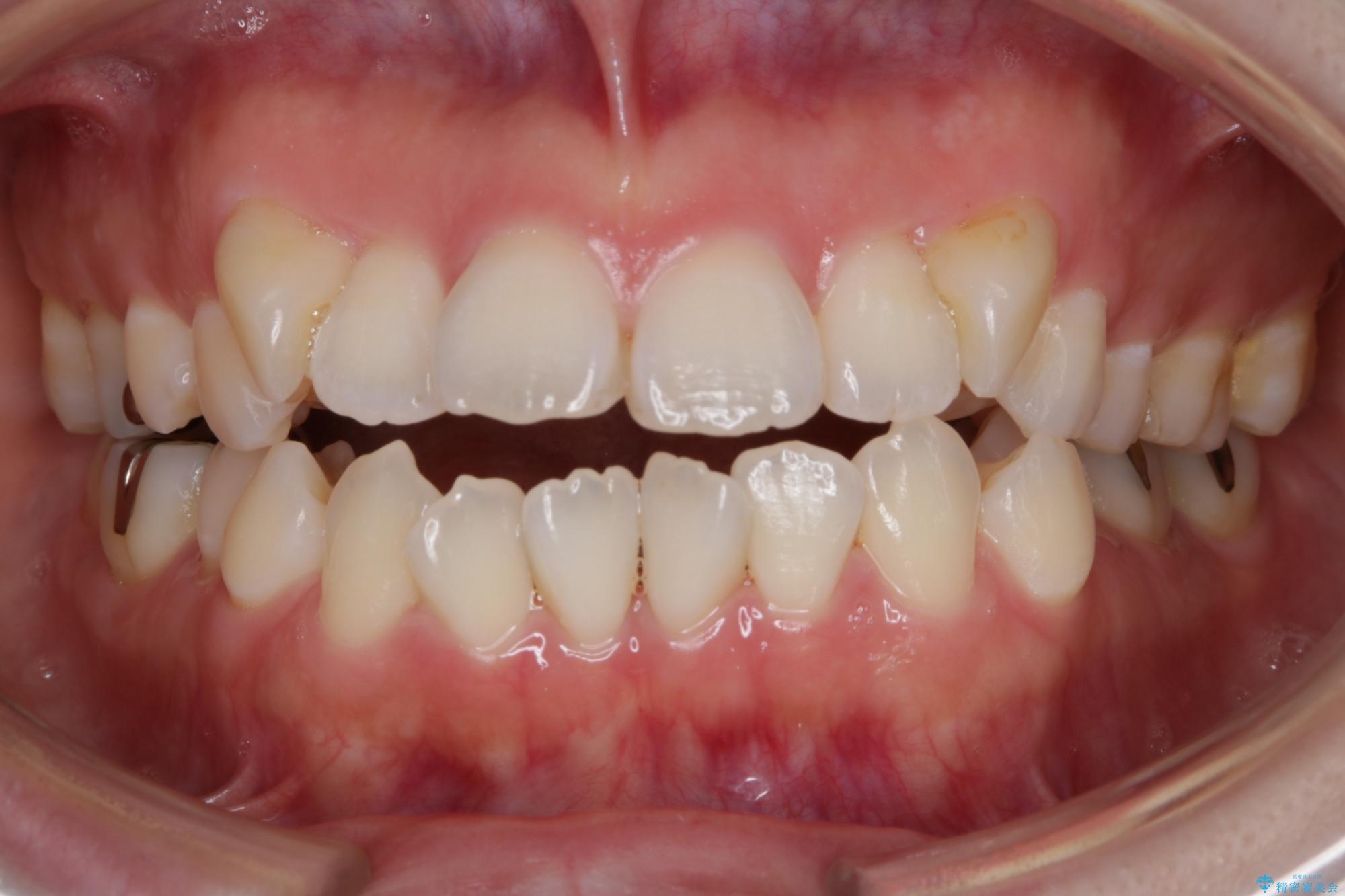 30代 女性　インビザラインで抜歯矯正 治療前