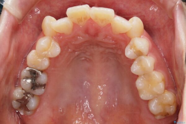 30代 女性 インビザラインで抜歯矯正