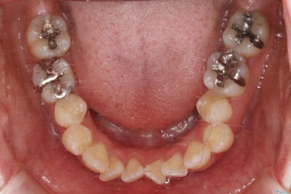 30代 女性 インビザラインで抜歯矯正