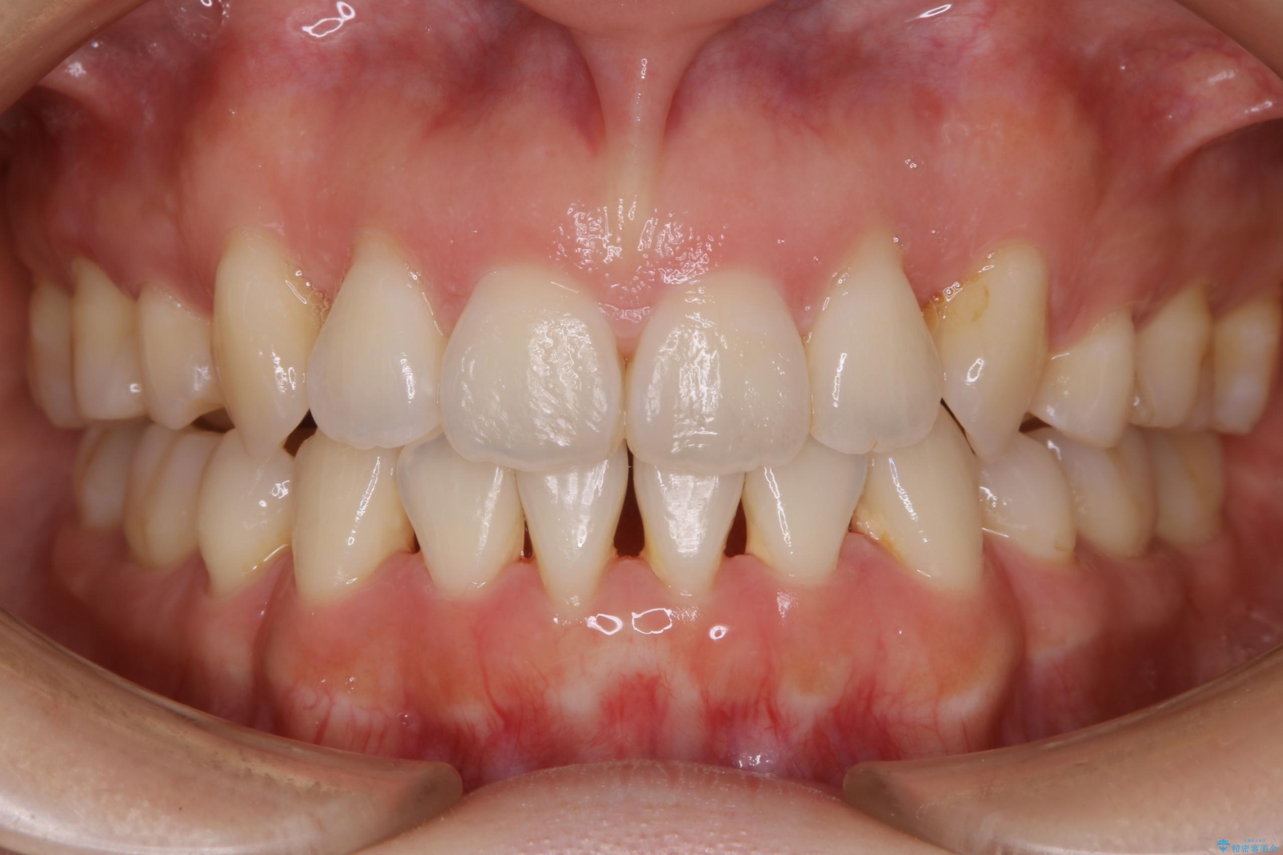 30代 女性 インビザラインで抜歯矯正 治療後