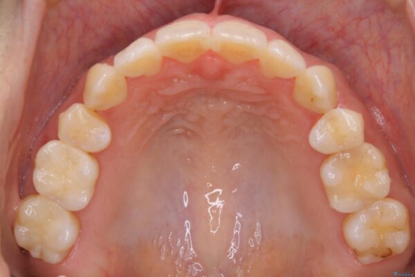 30代 女性 インビザラインで抜歯矯正