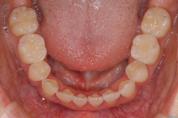 30代 女性 インビザラインで抜歯矯正